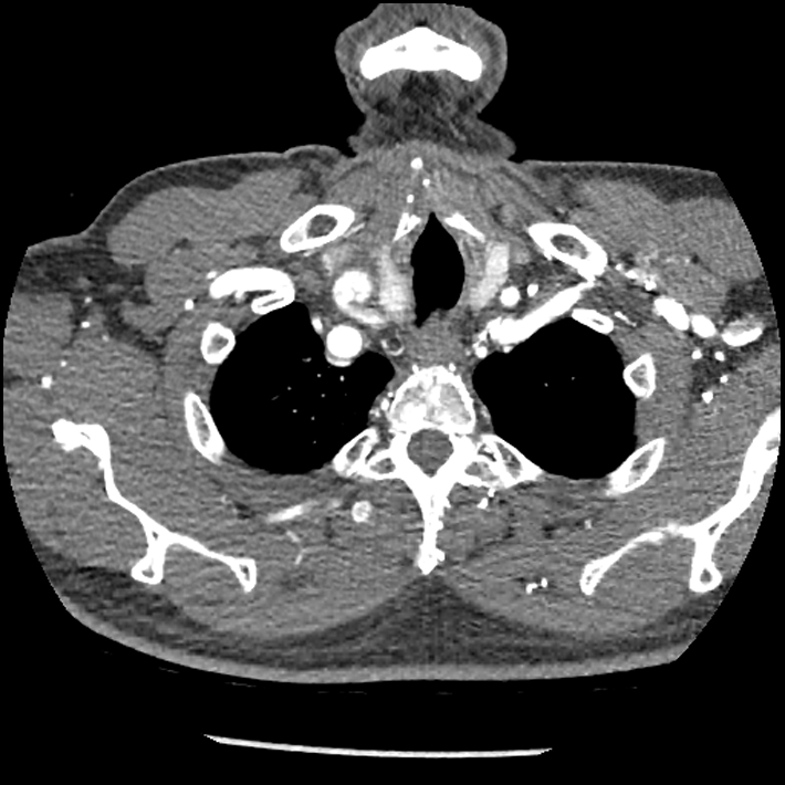 Aortic dissection - DeBakey Type I-Stanford A (Radiopaedia 79863-93115 A 2).jpg