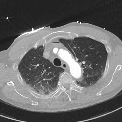 File:Aortic dissection - DeBakey type II (Radiopaedia 64302-73082 Axial lung window 17).png