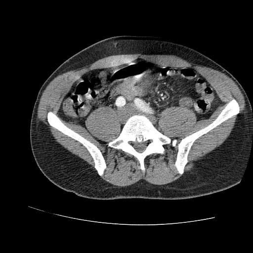 File:Aortic dissection - Stanford A -DeBakey I (Radiopaedia 28339-28587 B 171).jpg