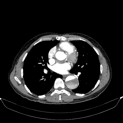 File:Aortic dissection - Stanford type A (Radiopaedia 83418-98500 A 35).jpg