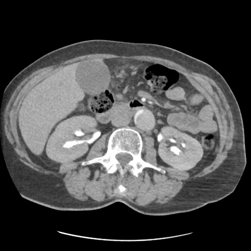 File:Aortic dissection - Stanford type B (Radiopaedia 50171-55512 A 60).png