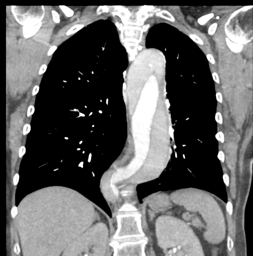 File:Aortic dissection - Stanford type B (Radiopaedia 50171-55512 B 56).png