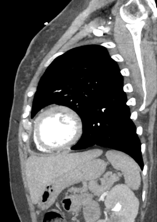 Aortic dissection - Stanford type B (Radiopaedia 50171-55512 C 2).png