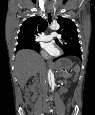 File:Aortic dissection - Stanford type B (Radiopaedia 73648-84437 B 60).jpg