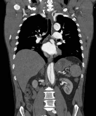 File:Aortic dissection - Stanford type B (Radiopaedia 73648-84437 B 66).jpg