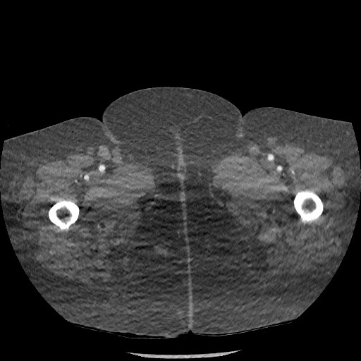 File:Aortic dissection - Stanford type B (Radiopaedia 88281-104910 A 177).jpg