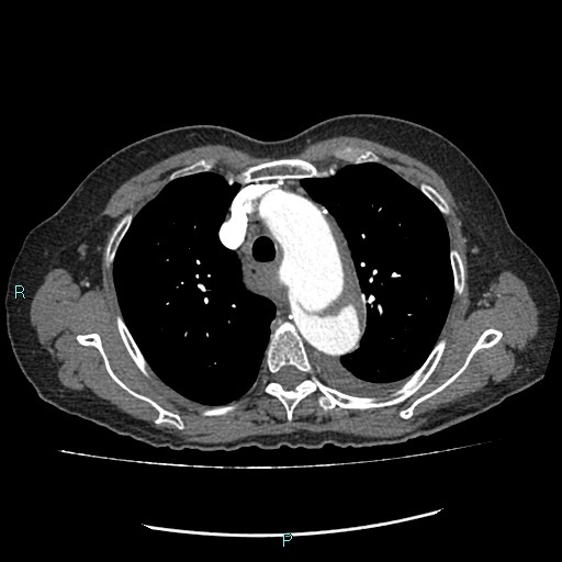 File:Aortic dissection extended to lusory artery (Radiopaedia 43686-47136 B 4).jpg