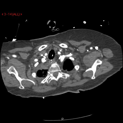 File:Aortic intramural hematoma (Radiopaedia 27746-28001 A 14).jpg