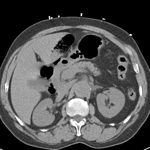File:Aortic intramural hematoma (Radiopaedia 31139-31838 Axial non-contrast 57).jpg