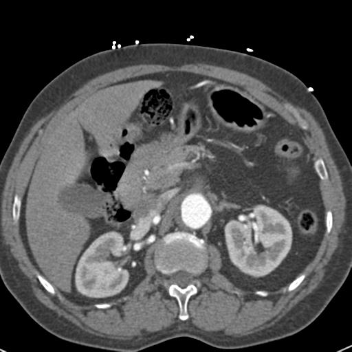 File:Aortic intramural hematoma (Radiopaedia 31139-31838 B 94).jpg