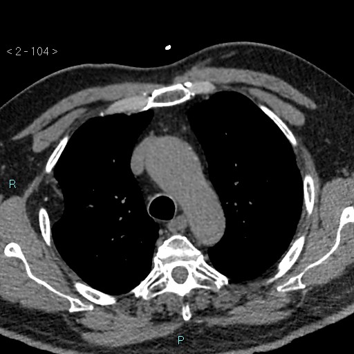 File:Aortic intramural hematoma (Radiopaedia 48463-53380 Axial non-contrast 46).jpg