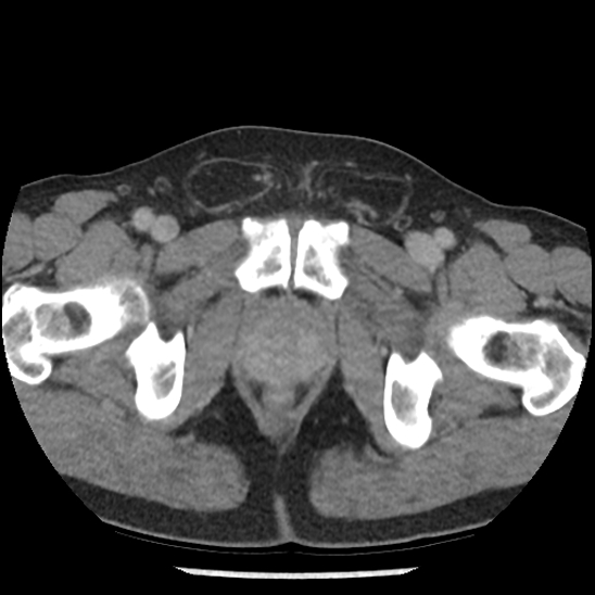 Aortic intramural hematoma (type B) (Radiopaedia 79323-92387 Axial C+ delayed 116).jpg