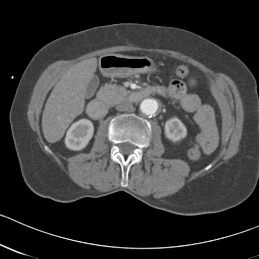 Aortic intramural hematoma from penetrating atherosclerotic ulcer (Radiopaedia 31137-31836 A 105).jpg