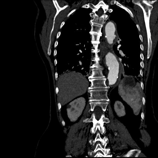 File:Aortic intramural hematoma from penetrating atherosclerotic ulcer (Radiopaedia 31137-31836 C 48).jpg