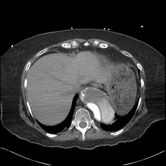 Aortic intramural hematoma with dissection and intramural blood pool (Radiopaedia 77373-89491 B 92).jpg