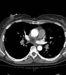 Aortic valve endocarditis (Radiopaedia 87209-103485 C 46).jpg