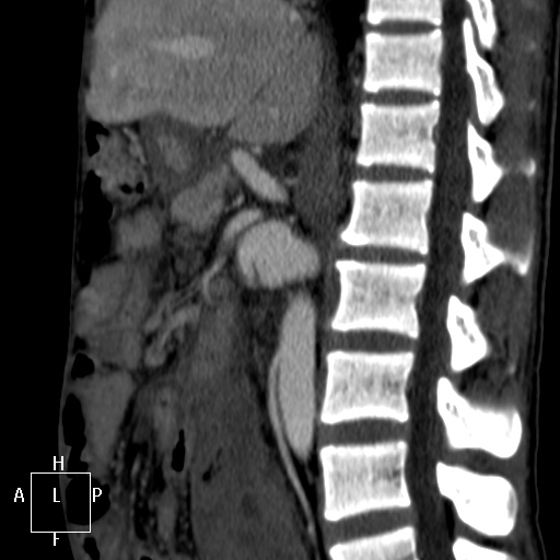 Aorto-left renal vein fistula (Radiopaedia 45534-49628 C 32).jpg