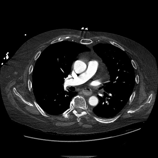 Aortoesophageal fistula with endovascular repair (Radiopaedia 73781-84592 Axial C+ CTPA 72).jpg