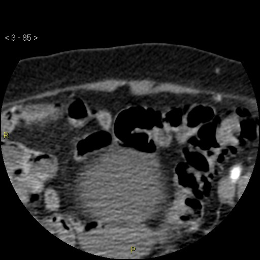 Aortoiliac occlusive disease (Radiopaedia 16828-16548 A 85).jpg