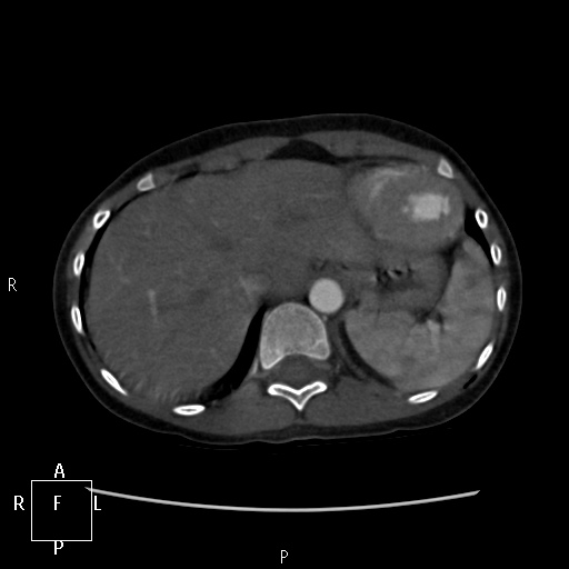 File:Aortopulmonary septal defect (Radiopaedia 41990-45013 Axial C+ CTPA 5).jpg