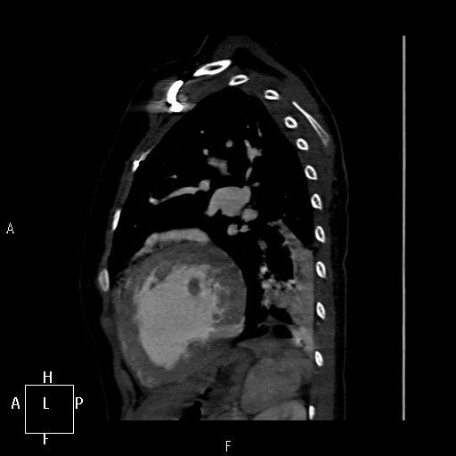 File:Aortopulmonary septal defect (Radiopaedia 41990-45013 Sagittal C+ CTPA 5).jpg