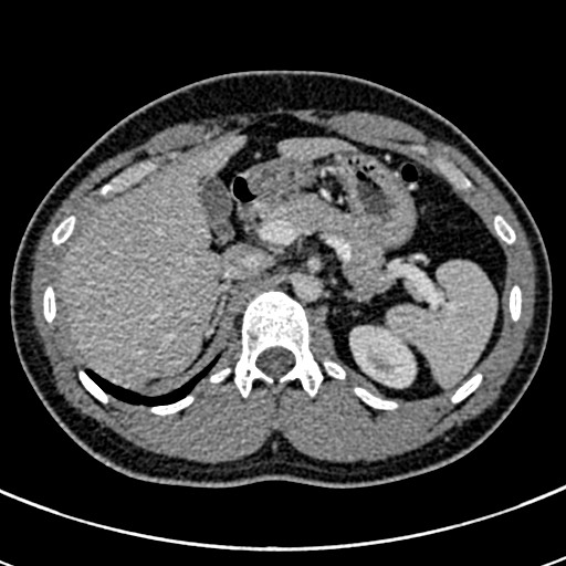 Apical lung mass mimic - neurogenic tumor (Radiopaedia 59918-67521 A 86).jpg