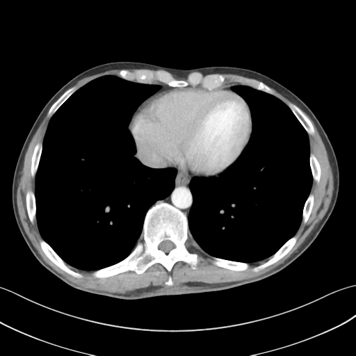 File:Apical pleural calcification (Radiopaedia 46141-50499 Axial C+ delayed 51).png