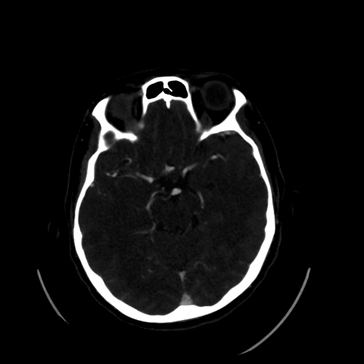 Aplasia of the internal carotid artery (Radiopaedia 61082-68960 A 28).jpg