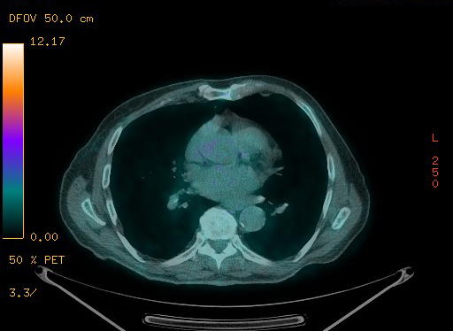 Appendiceal adenocarcinoma complicated by retroperitoneal abscess (Radiopaedia 58007-65041 Axial PET-CT 74).jpg