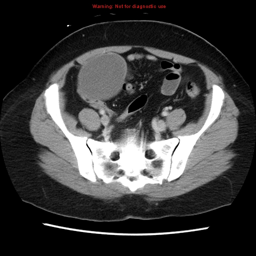 Appendiceal mucinous cystadenoma (Radiopaedia 8263-9111 Axial liver window 62).jpg