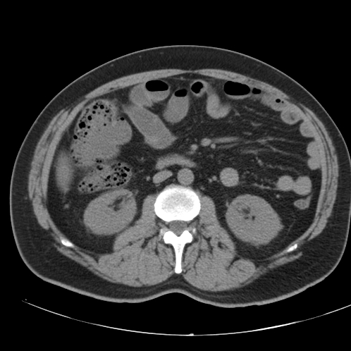 Appendicitis and giant appendicolith (Radiopaedia 80251-93588 Axial non-contrast 25).jpg