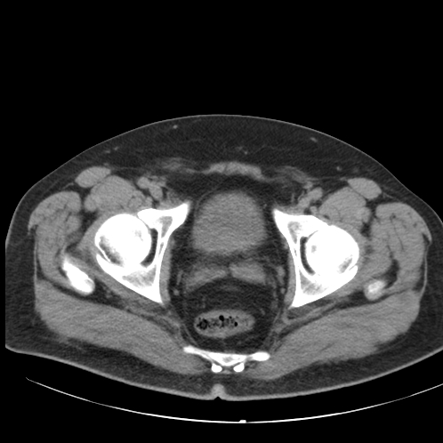 File:Appendicitis and giant appendicolith (Radiopaedia 80251-93588 Axial non-contrast 55).jpg