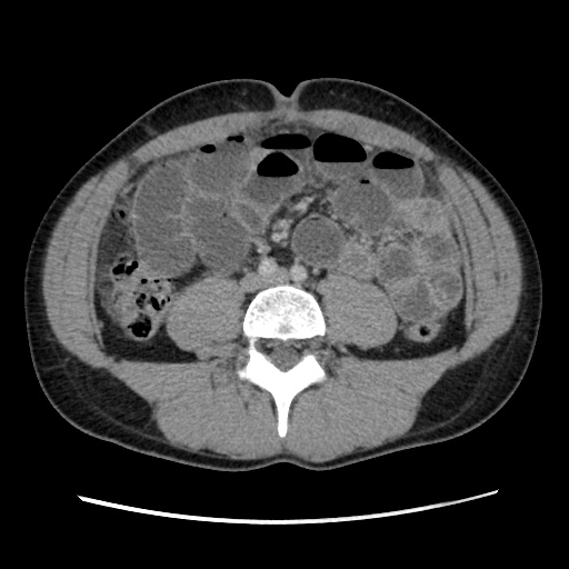 Appendicitis complicated by post-operative collection (Radiopaedia 35595-37114 A 51).jpg