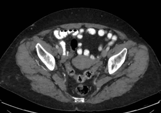 File:Appendicitis due to chicken fibula (Radiopaedia 74314-85198 A 43).jpg