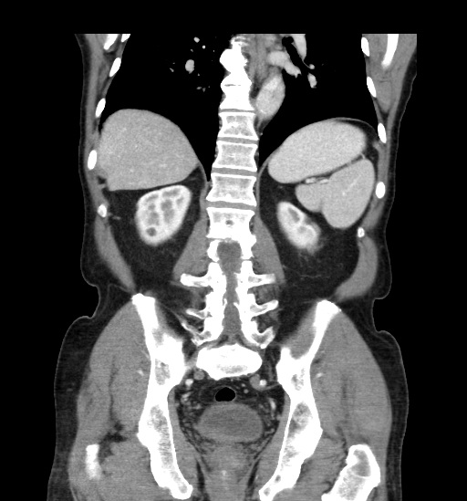 Appendicitis with localized perforation and abscess formation (Radiopaedia 49035-54130 B 35).jpg