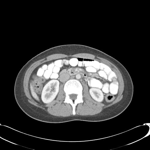 File:Appendicitis with minimal stranding but appendicolith (Radiopaedia 29035-29397 A 38).jpg