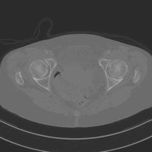 April fools' 2019- calcified peritoneal arachnoidosis (Radiopaedia 67273-76636 Axial bone window 54).png