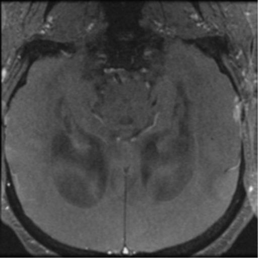 Aqueduct stenosis with corpus callosum hypoattenuation post shunting (Radiopaedia 37212-38969 Axial CSF Flow 48).png