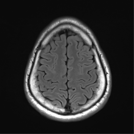 File:Arachnoid cyst - cerebellopontine angle (Radiopaedia 59689-67083 Axial FLAIR 31).png
