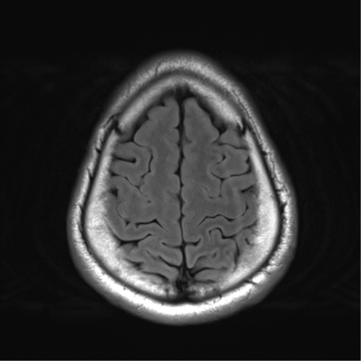 File:Arachnoid cyst - cerebellopontine angle (Radiopaedia 59689-67083 Axial FLAIR 32).png