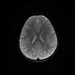 File:Arachnoid cyst - middle cranial fossa (Radiopaedia 86780-102938 Axial DWI 40).jpg