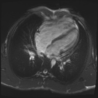 File:Arrhythmogenic right ventricular cardiomyopathy (Radiopaedia 57972-64966 A 19).jpg