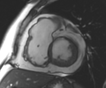 Arrhythmogenic right ventricular cardiomyopathy (Radiopaedia 69431-79307 Short axis cine 148).jpg