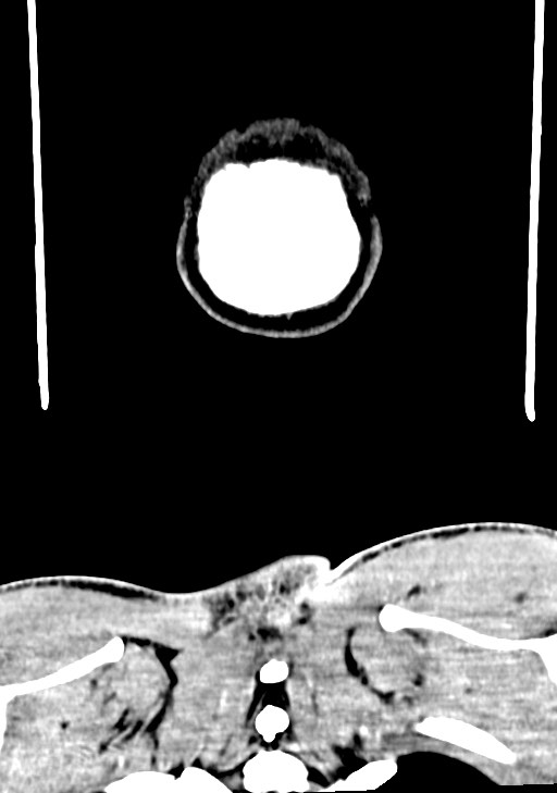 Arrow injury to the brain (Radiopaedia 72101-82607 Coronal non-contrast 71).jpg
