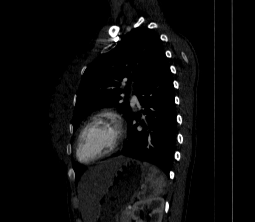 Arteria lusoria (Radiopaedia 88528-105192 C 65).jpg