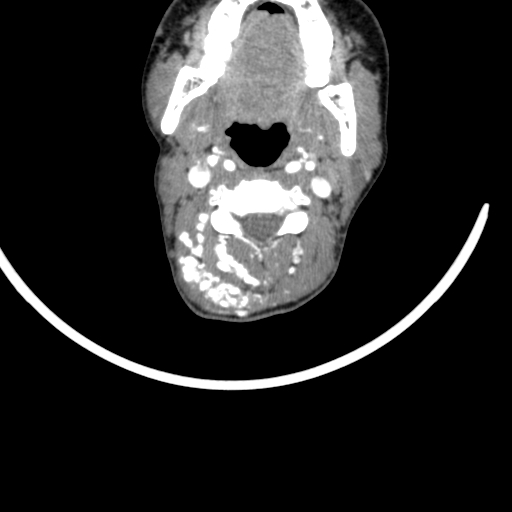 Arteriovenous malformation of the neck (Radiopaedia 53935-60062 A 41).jpg