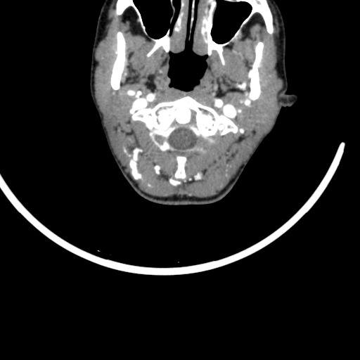 File:Arteriovenous malformation of the neck (Radiopaedia 53935-60062 A 56).jpg