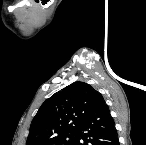 File:Arteriovenous malformation of the neck (Radiopaedia 53935-60062 C 10).jpg