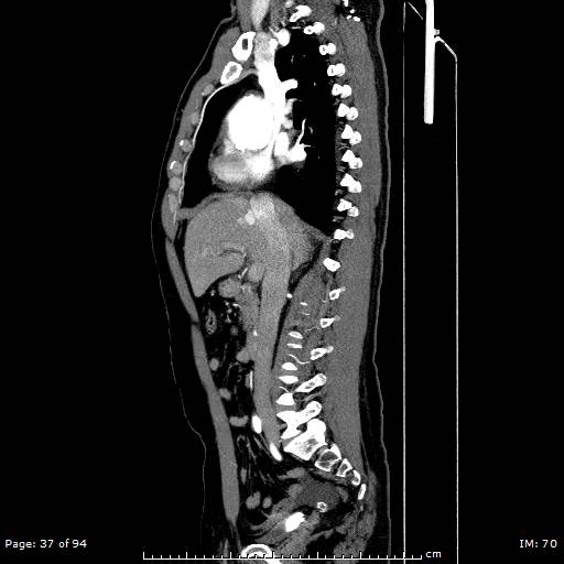File:Ascending aortic aneurysm (Radiopaedia 50086-55404 C 26).jpg