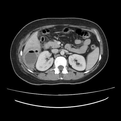 Ascending retrocecal appendicitis with liver abscesses (Radiopaedia 60066-67615 B 36).jpg